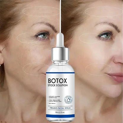 BOTOX™ | Rynkefri hud på bare få uger! | 1+1 GRATIS!